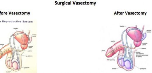Vasectomy: Is it the right option for me?