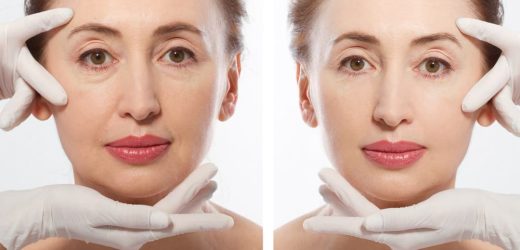 Getting a Full Facelift Can Help You to Look More Youthful