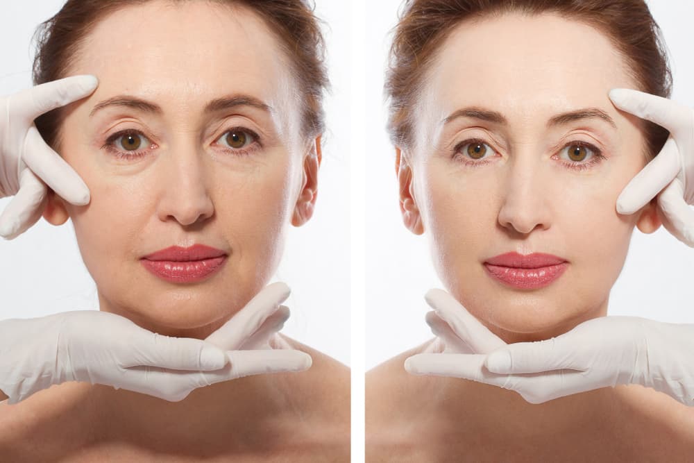 Getting a Full Facelift Can Help You to Look More Youthful