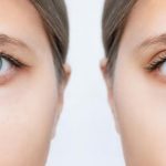Find Out The Best Age For a Ptosis Surgery in Singapore