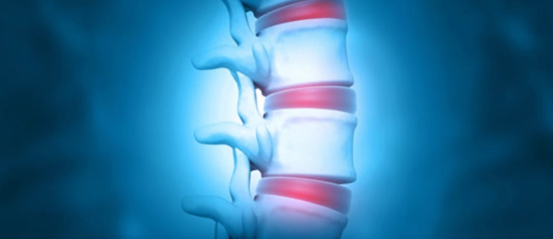Can Degenerative Disc Disease Go Away on Its Own?
