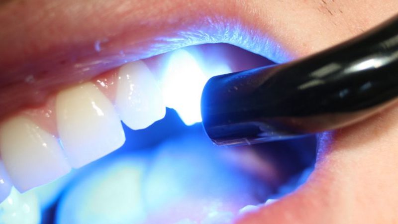 Composite Fillings For Long-lasting Oral Rehabilitation